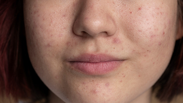 shramy-i-postakne-metody-korrektsii-i-vosstanovlenie-kozhi-posle-vospaleniy